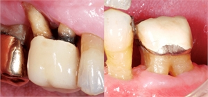 Tooth furcation defect in a clinical situation