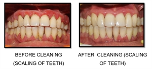 Dental scaling removes the calcified plaque, called teeth tartar, and cleans the superficial stains off the enamel surface