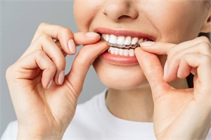 Why Choose 6 Month Braces Over Traditional Braces in Miami