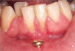 Gum recession due to lip piercing.