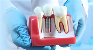 Understanding the Role of the Implant Abutment in Dental Implants at Town Dental, Chaska