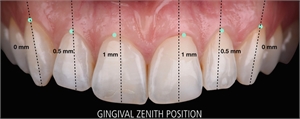 Gingival zenith point in dentistry