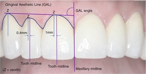 Gingival aesthetic line GAL and gingival aesthetic angle