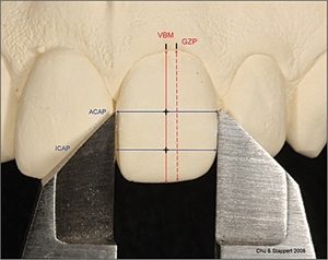 Gingival zenith point GZP is the highest apical point of the marginal gingival curve