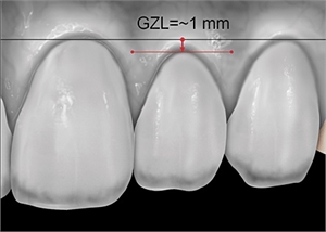 Gingival zenith level is the distance between the gingival zenith points of the lateral incisor and central insizor. It is normally between 0 - 1.8 mm