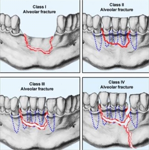 Types of alveolar fracture. Classification of alveolar process fractures
