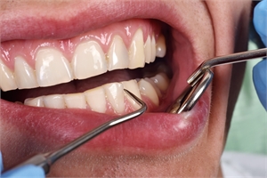 The Foundation of Oral Health: When Do You Need a Periodontal Maintenance Plan Instead of a Regular Cleaning?