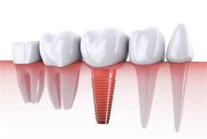 Are Dental Implants Right for You Key Benefits and Considerations