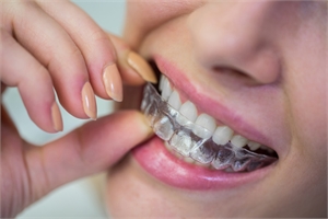 Why Invisalign is the Best Choice for Straightening Your Teeth