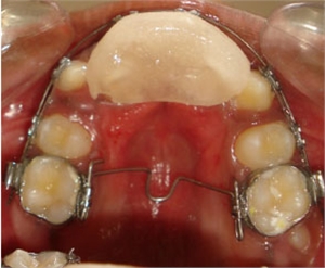 Inclined plane in mouth