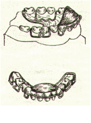 Inclined plane - anterior and lateral look