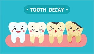 Teeth Cavities 