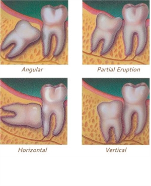 Eruption of Third Molars