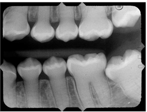 Note the shell tooth appearance with absence of pulp chambers in them.