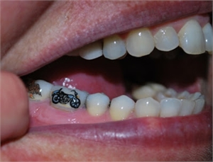 Tooth Tattoo