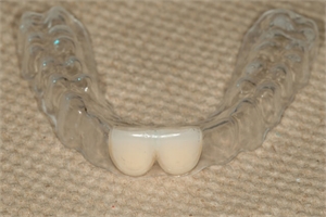 Essix retainer replacing front two upper incisors