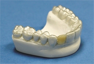 What is Essix Retainer? | News | Dentagama