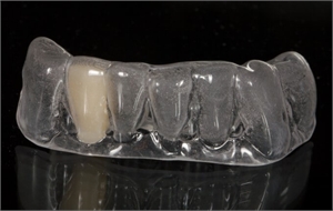 Invisible retainer with a fake tooth to fill up the gap and restore the missing tooth in the arch