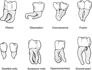 Concrescence, Dilaceration, Dwarfed Roots, Fusion, Flexion, Accessory roots, Hypercementosis