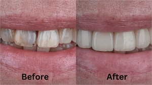 Achieve A Hollywood Smile With The Best Quality Veneers In Miami