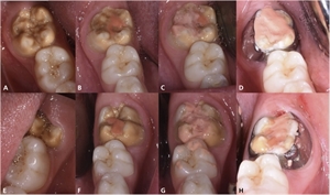 What does MIH mean in dentistry