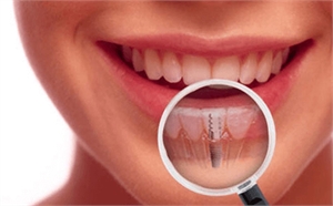 What Is The Dental Implant Treatment Everything You Need To Know