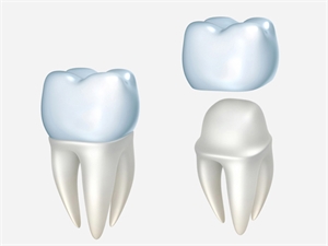 Dental Crown