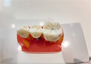 Discover Dental Bridge Cost in Abu Dhabi Your Essential Guide