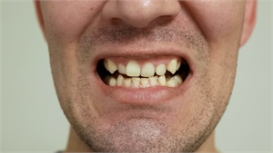Worn Teeth Causes Consequences and Solutions in Vancouver