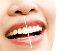 9 Benefits of Professional Teeth Whitening You Should Know