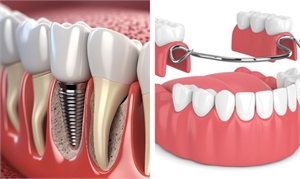 Dentures VS Dental Implants