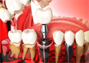 Dental Implants in Sydney by Experienced Dentists in Sydney