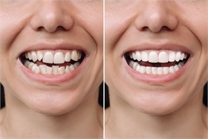 Dental Veneers