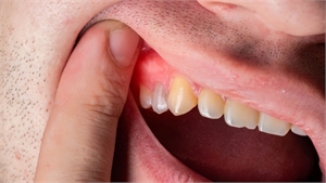 Periodontal Treatment