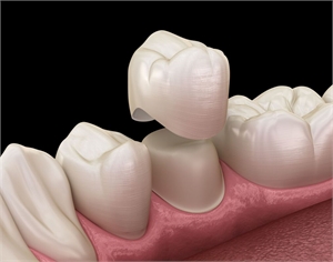 Dental Crowns