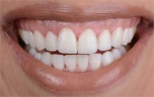 gum contouring treatment