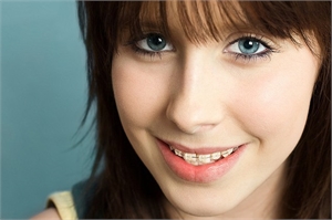 Preventing Cavities While Wearing Braces