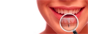 Dental implants