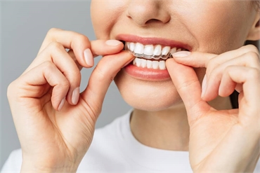 Why Choose 6 Month Braces Over Traditional Braces in Miami