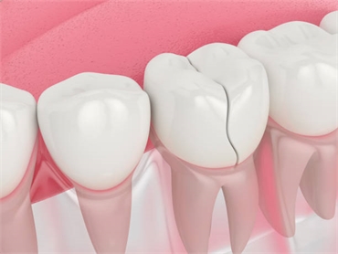 An overview by dentist in Cambridge for broken or chipped teeth