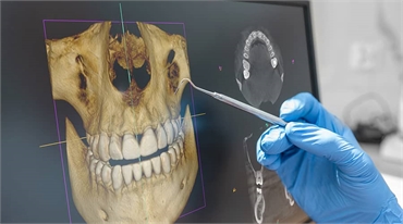 Why Is a 3D Dental Scan Important in Dentistry
