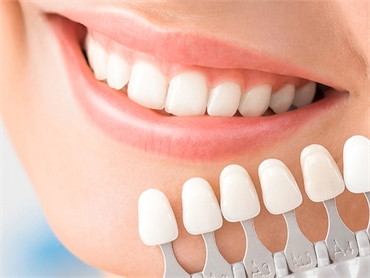 Achieve a Flawless Smile with Cosmetic Teeth Veneers