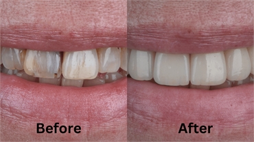 Achieve A Hollywood Smile With The Best Quality Veneers In Miami