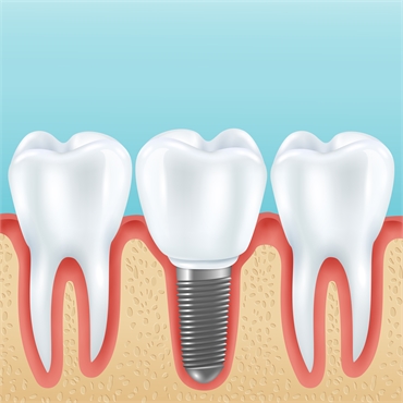  Caring for Your Dental Implants with Expert Tips from Langley Dentists