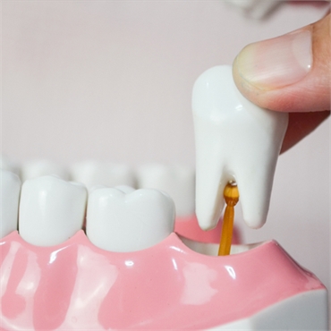 Wisdom Teeth Removal