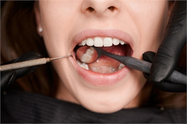 A Comprehensive Guide to Preventing Cavities Between Teeth