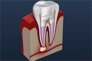 Pulpectomy A Complete Guide to Saving Your Childs Teeth