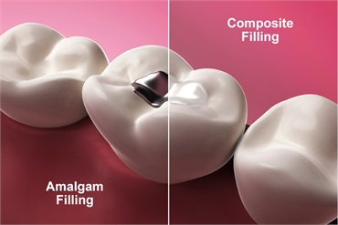 How to Replace Old Metal Fillings with Tooth Colored Composites a Guide from a Boise Cosmetic Dentist