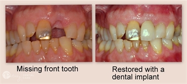 Dental Implants