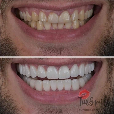 before after laminate veneers turkey